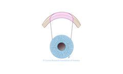 Corneal Transplant