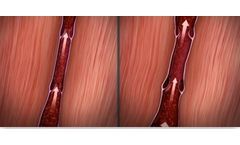 VenoValve - Surgically Implanted Valve for Chronic Venous Insufficiency (CVI)