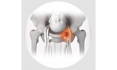 Neuromuscular Electrostimulation Device for VTE Prevention – Obstetrics - Hospital Applications