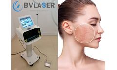 980nm diode laser for vascular removal