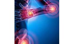 Novel Biomarkers May Help Predict the Susceptibility of a Population to Rheumatoid Arthritis